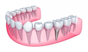 Implantes Dentários de Titânio