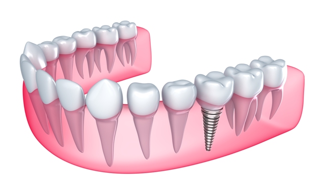 Passos para a Colocação de Implantes Dentários