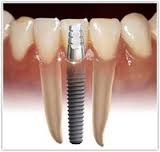 Implante + dente em 1 dia.